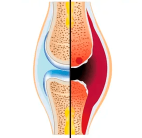 Sveiko ir susidėvėjusio sąnario struktūra su kremzlės audinio ir sinovinio skysčio žymėjimu