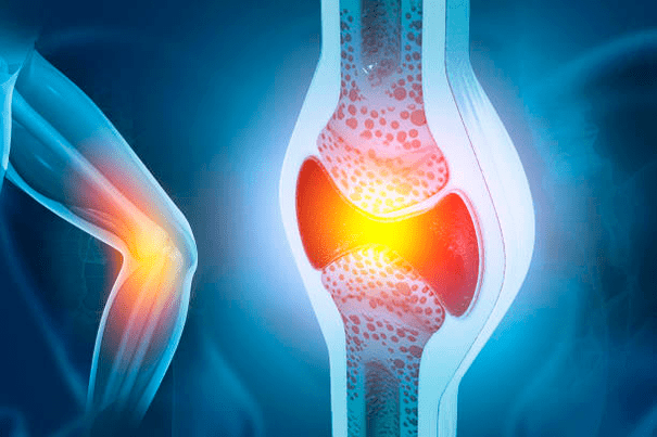 Sąnarių ligų profilaktika